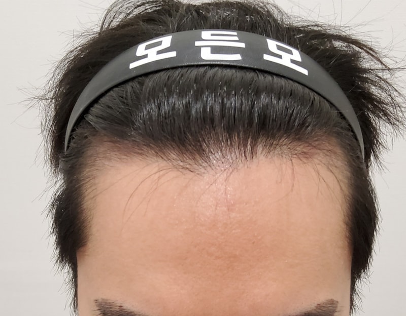 3. 수술후_3개월_1.jpg