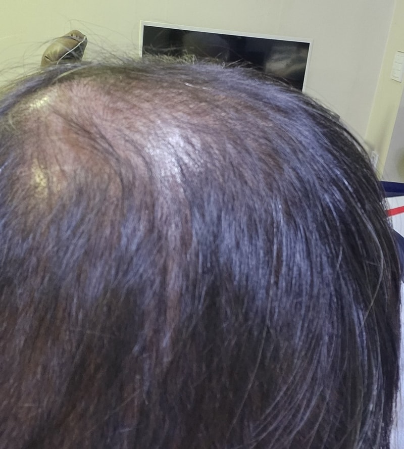 3. 수술후_3개월_셀카_3.jpg