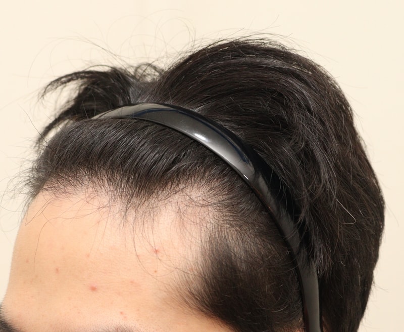 1. 수술전_2.JPG