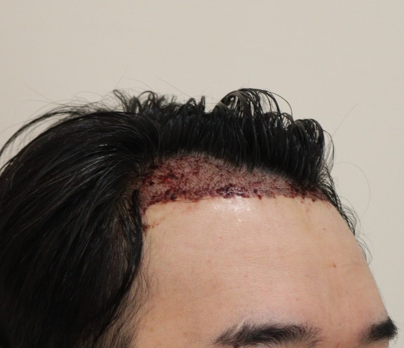 2. 수술후_1일_3.JPG