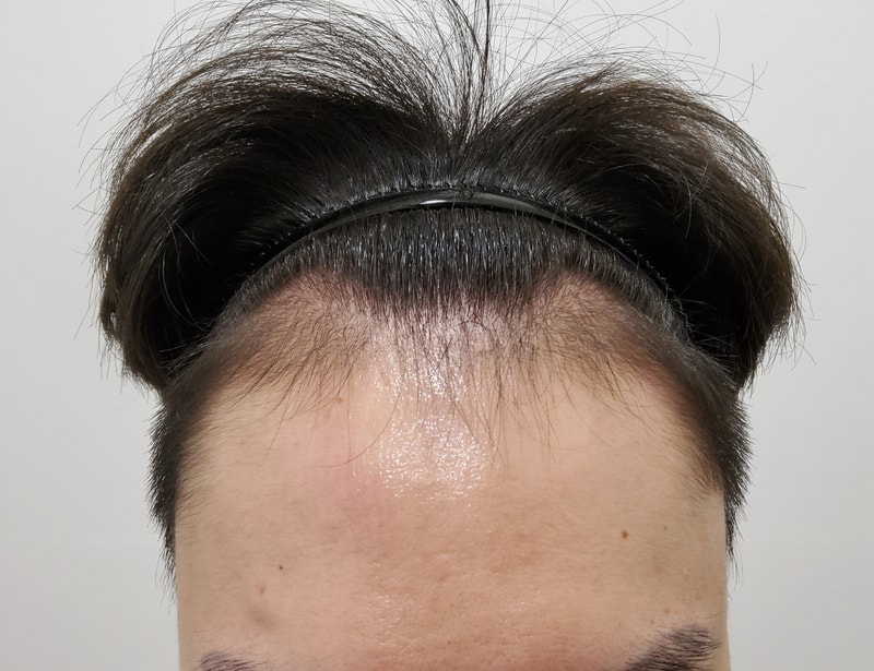 Three months of hair transplantation