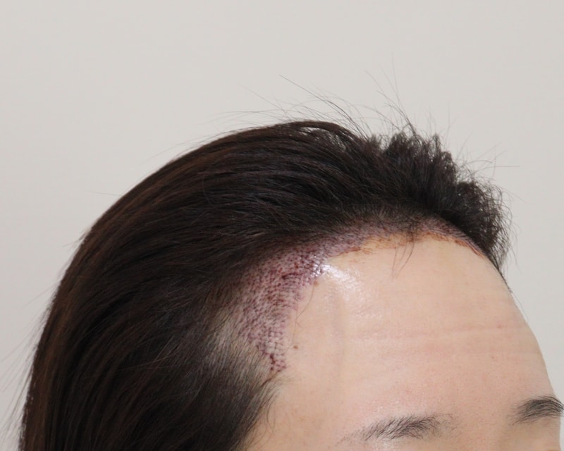 2. 수술후_1일_3.JPG