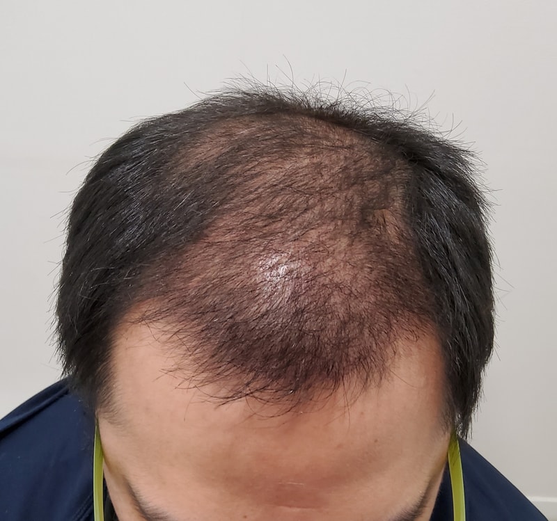 3. 수술후_3개월_2.jpg