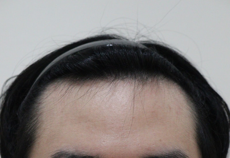 ヘアライン毛髪移植3ヶ月目になりました~
