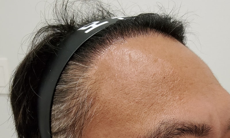 5. 수술후_6개월_3.jpg
