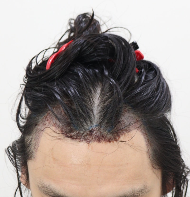 2. 수술후_1일_1.JPG