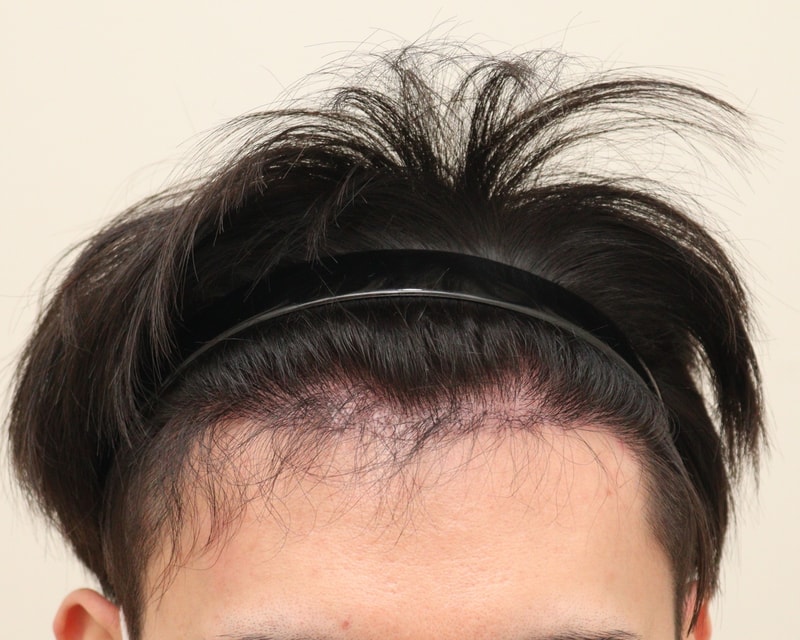 4. 수술후_6개월_1.JPG