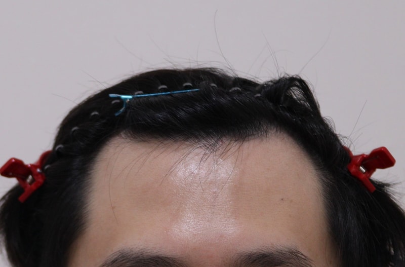 비절개로 1800모 이식했어요~