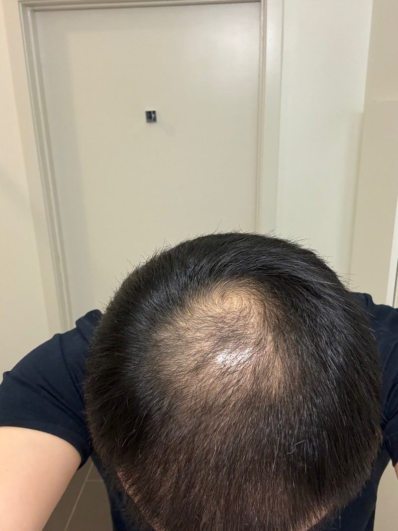 3. 수술후_3개월_셀카_3.jpg