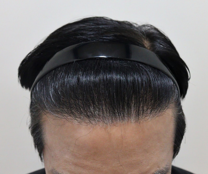 4. 수술후_1년_1.JPG