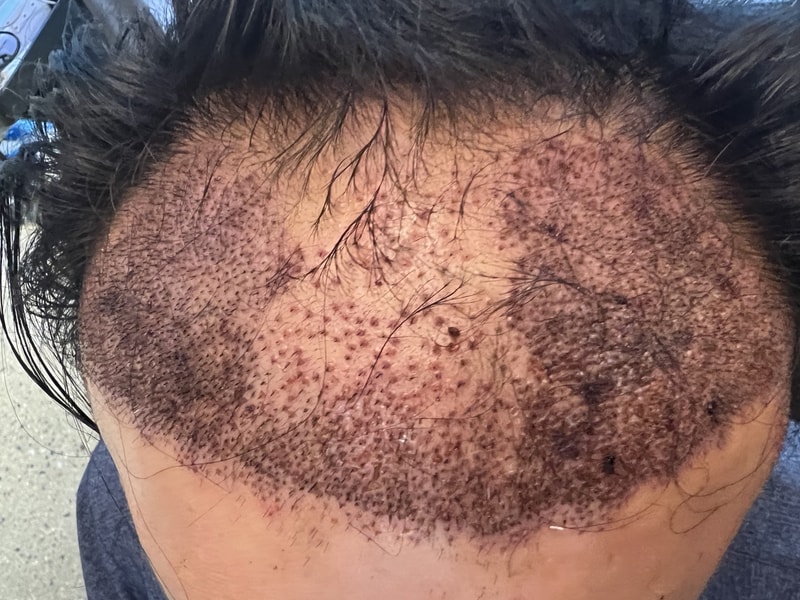 2. 수술후_1일_1.jpg