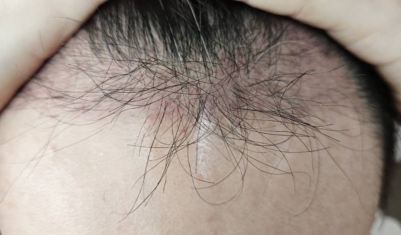 3. 수술후_3개월_셀카_1.jpg