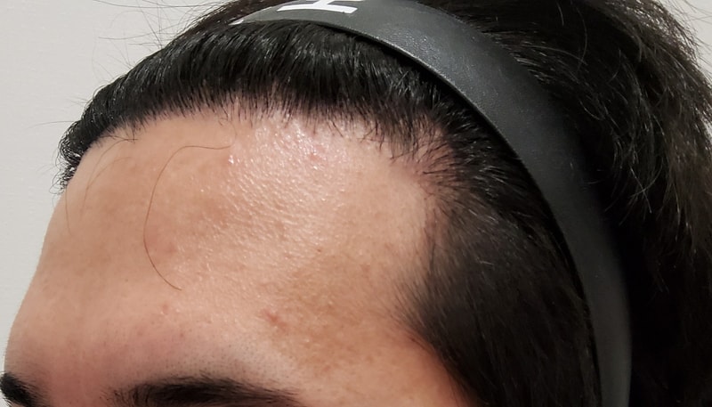 5. 수술후_1년_2.jpg