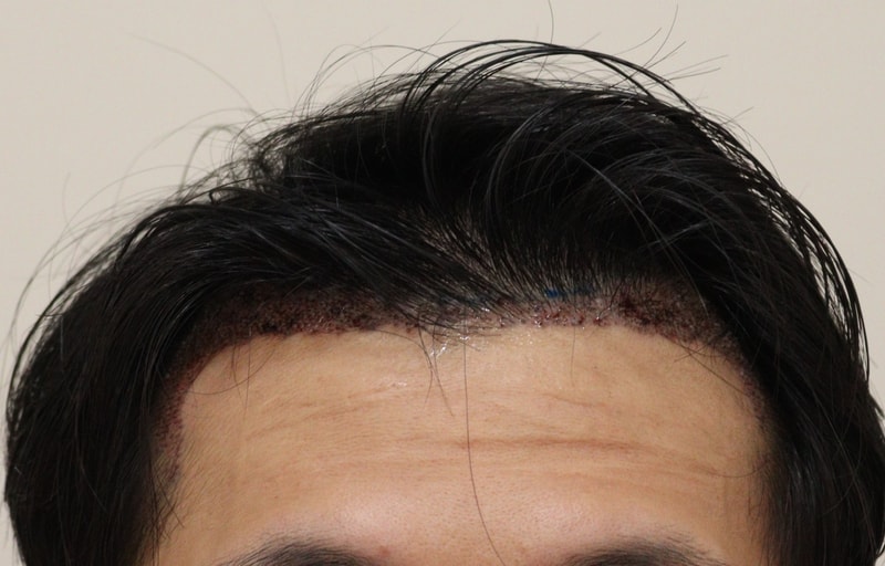 2. 수술후_1일_1.JPG