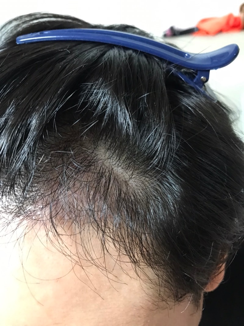 3. 수술후_3개월_셀카_2.jpg