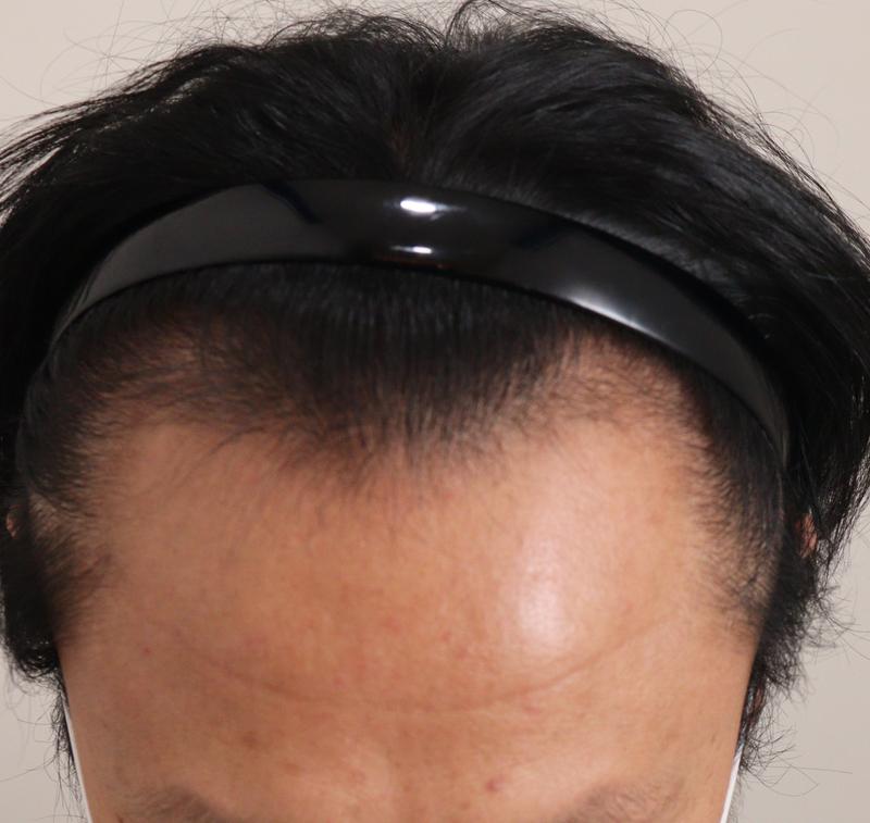 1. 수술전_1.JPG