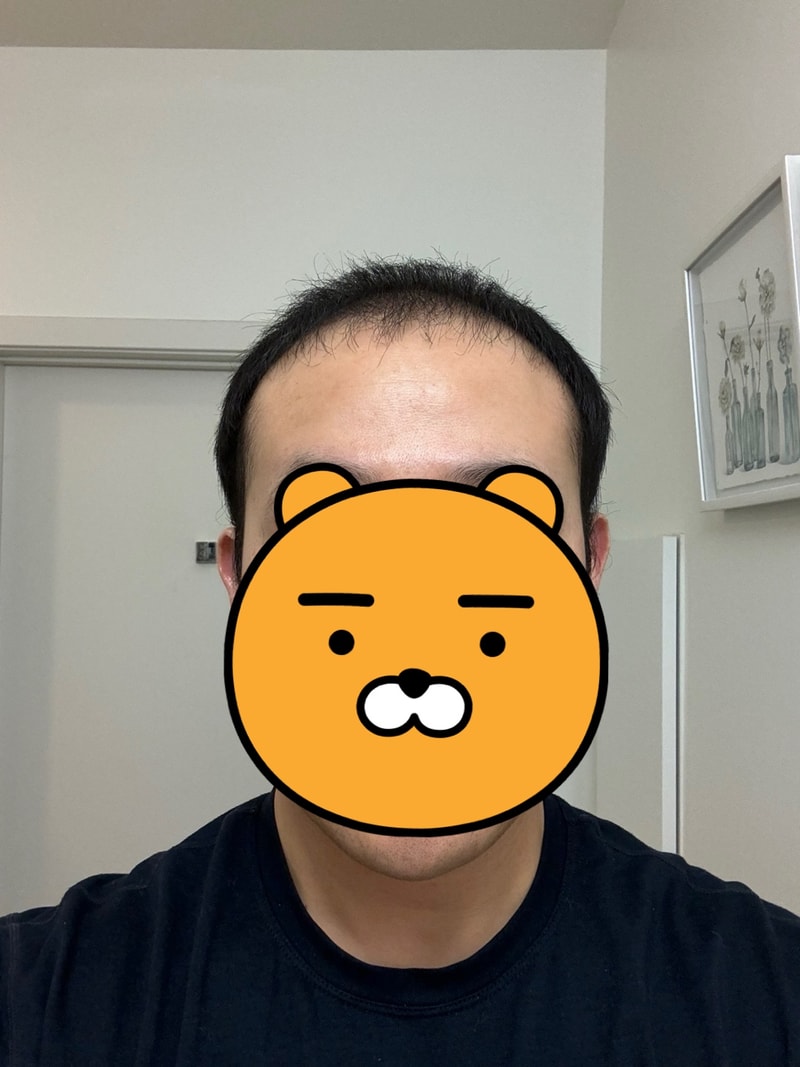 3. 수술후_3개월_셀카_1.jpg