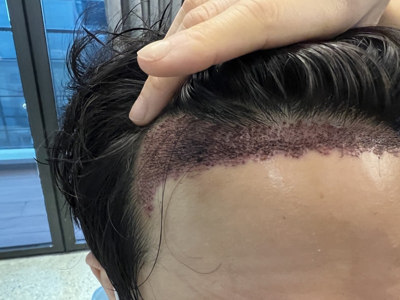 2. 수술후_1일_3.jpg