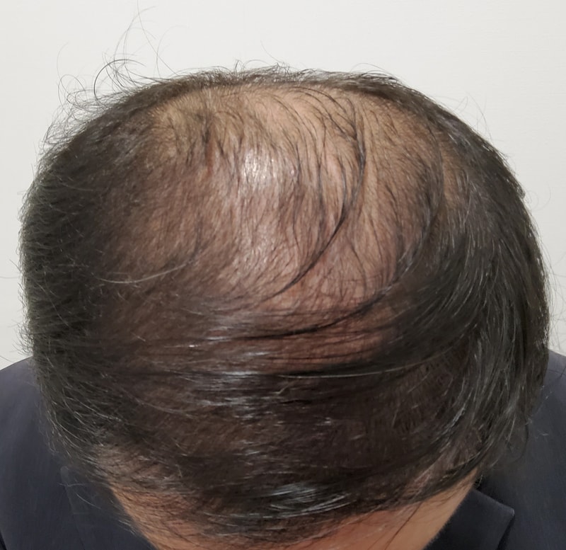 4. 수술후_6개월_2.jpg