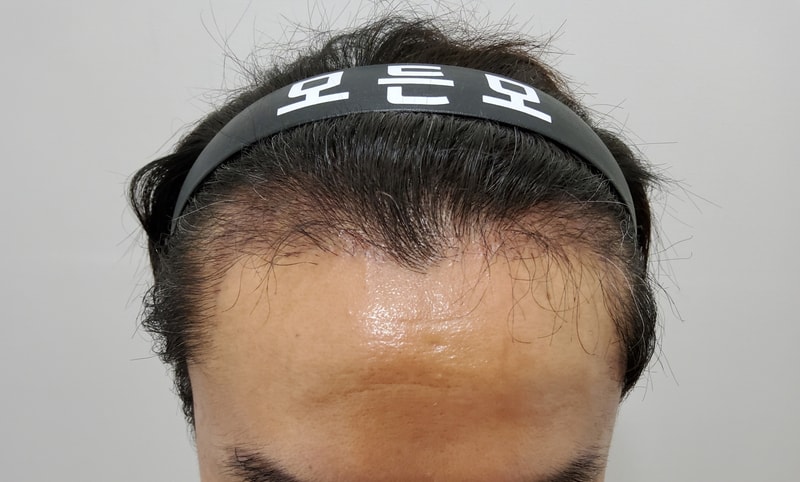 3. 수술후_3개월.jpg