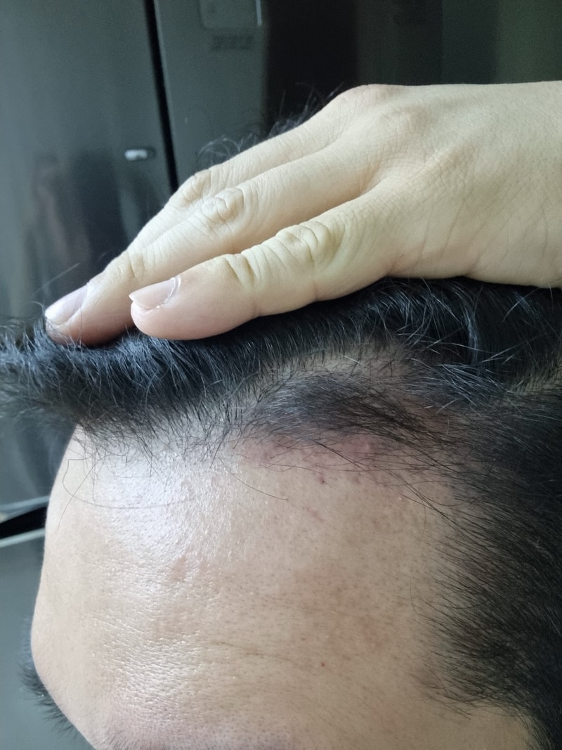 3. 수술후_3개월_셀카_1.jpg