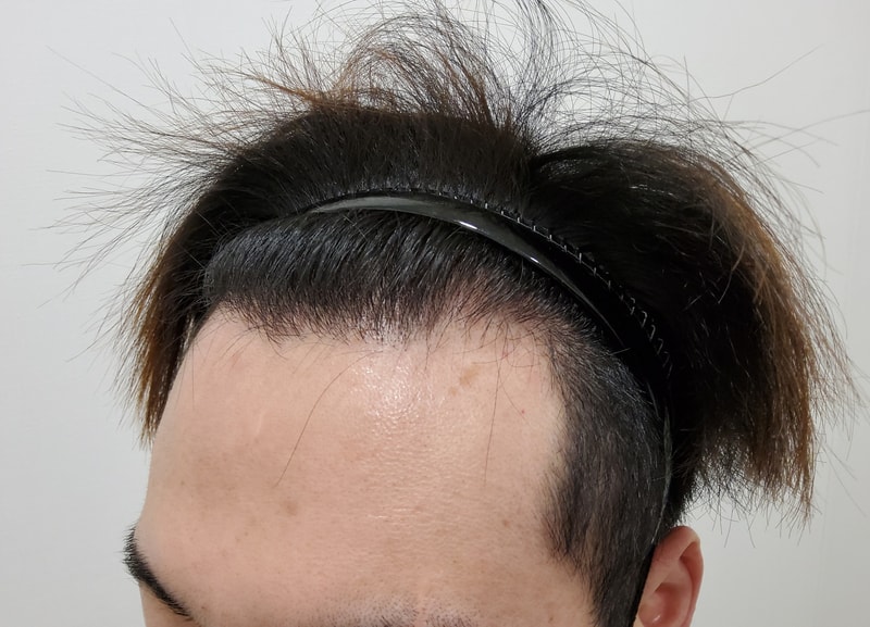 1. 수술전_2.jpg