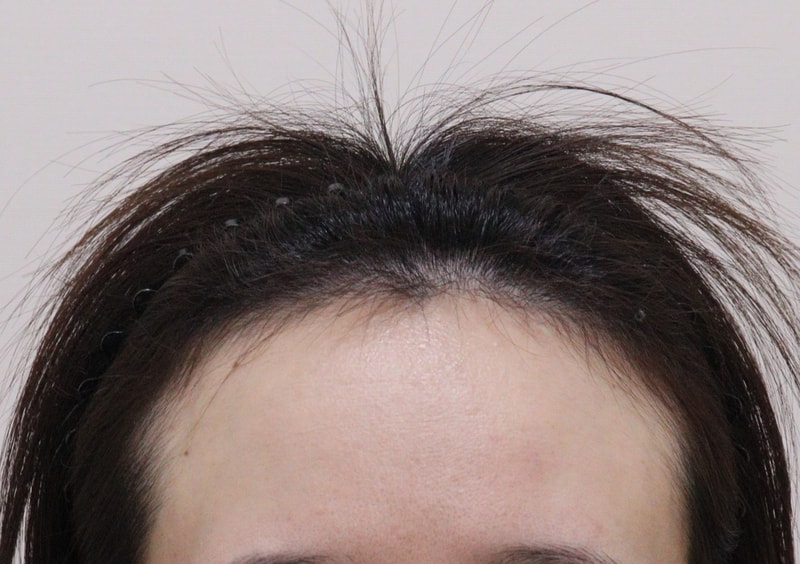 헤어라인 교정하고왔어요!