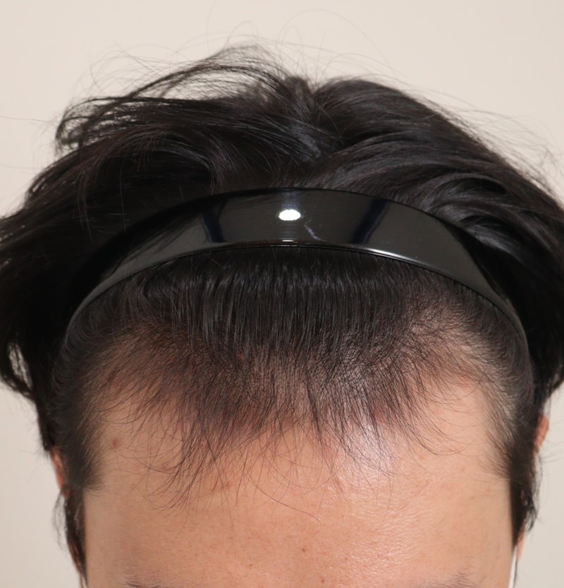 모발이식 일년차 찍었습니다