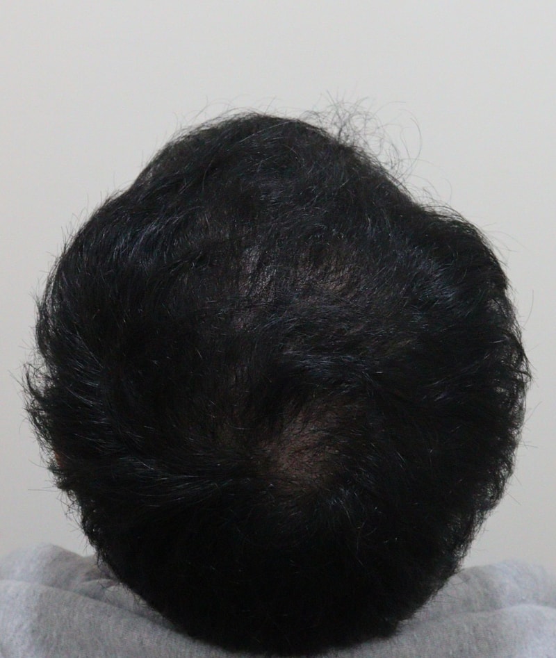 4. 수술후_6개월_2.JPG