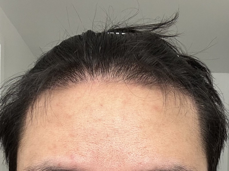 3.수술후_6개월_셀카1.jpg