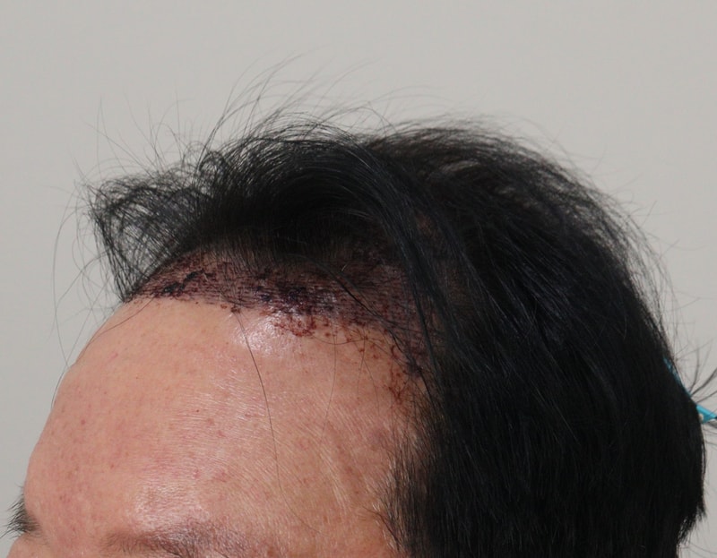 2. 수술후_1일_3.JPG