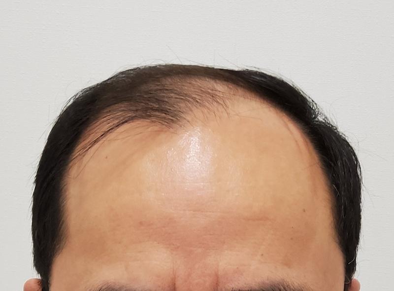I had a hair transplant to regain my youth.
