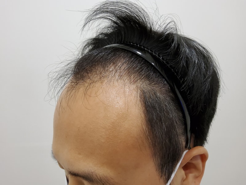 1. 수술전_2.jpg