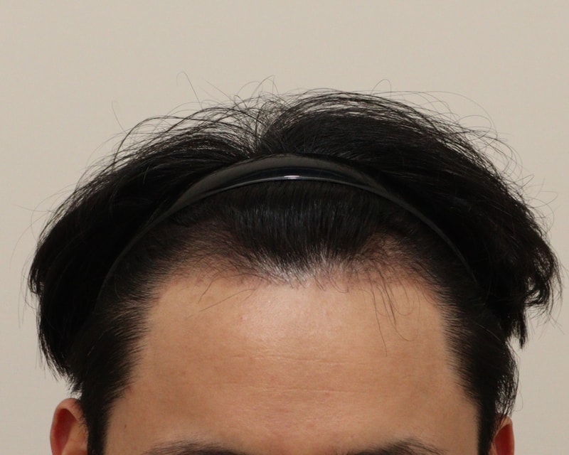 3. 수술후_3개월_1.JPG