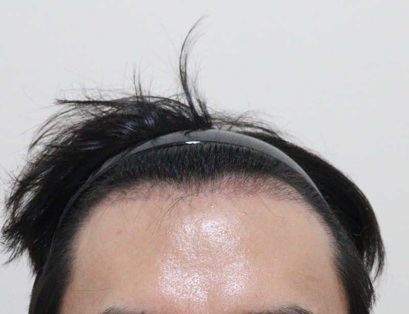 3. 수술후_3개월_1.JPG