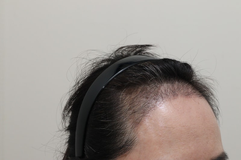 3. 수술후_3개월_3.JPG