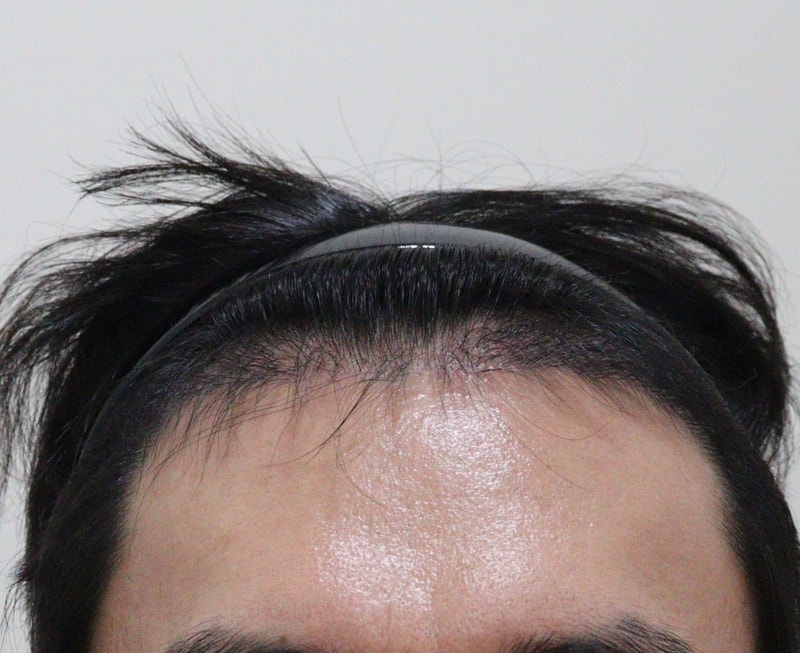 4. 수술후_5개월_1.JPG