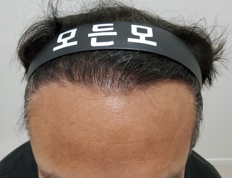 5. 수술후_6개월_1.jpg