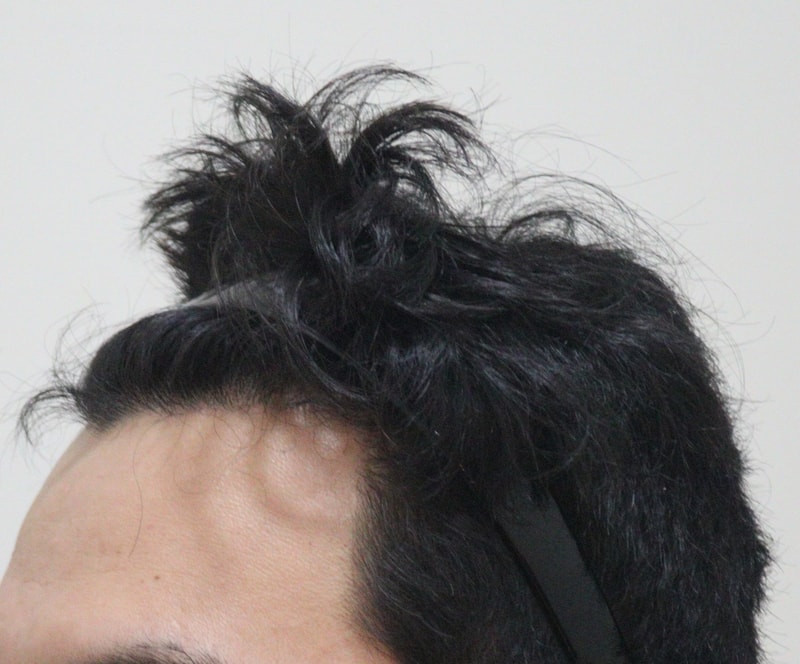 4. 수술후_7개월_3.JPG