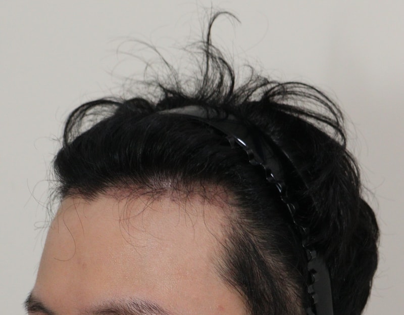 3. 수술후_3개월_2.JPG