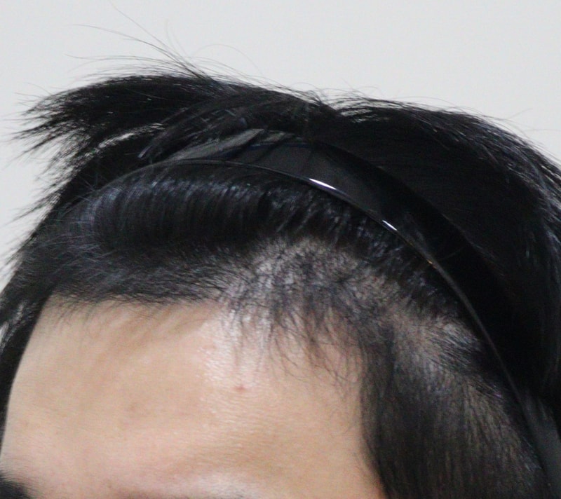 4. 수술후_6개월_2.JPG