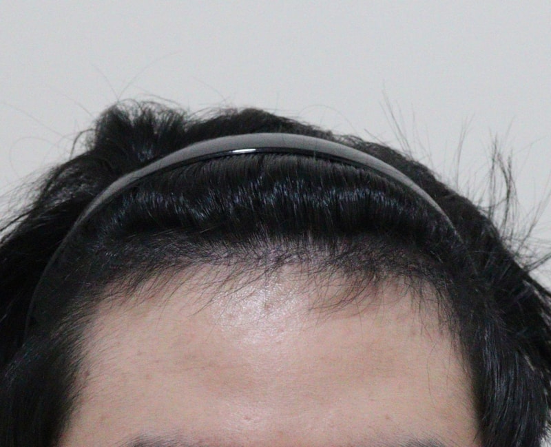 4. 수술후_6개월_1.JPG