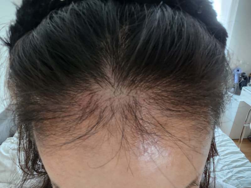 3. 수술후_3개월_셀카_1.jpg