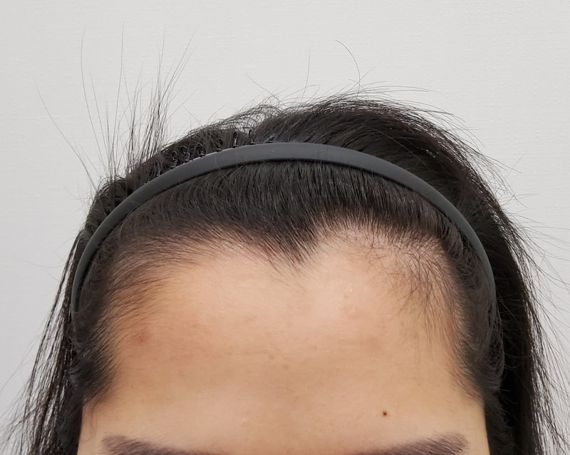 헤어라인 조금씩 자라는게 보이네요!