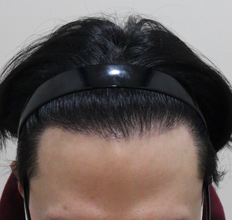 4. 수술후_7개월_1.JPG