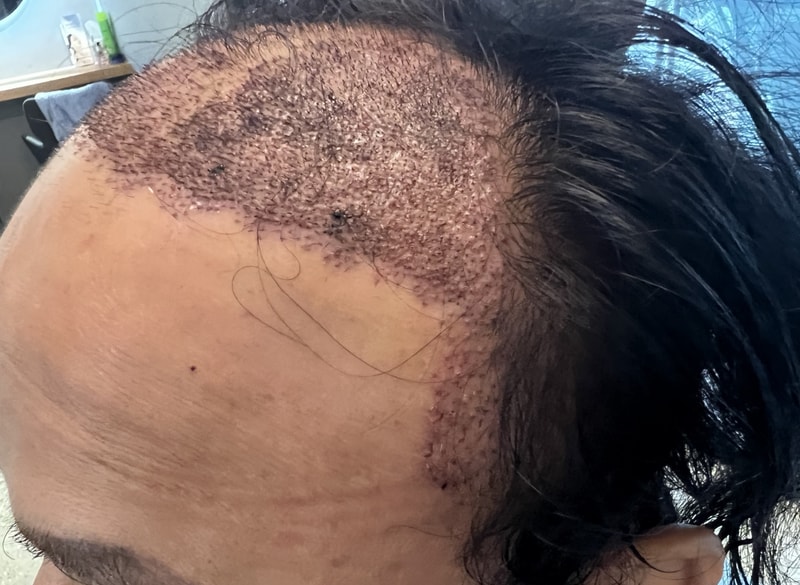 2. 수술후_1일_2.jpg