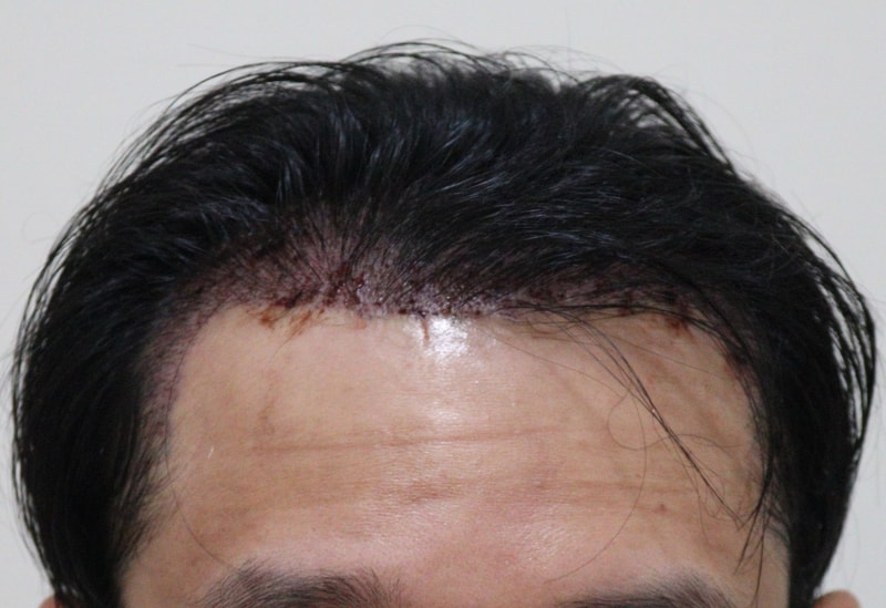 2. 수술후_1일_1.JPG