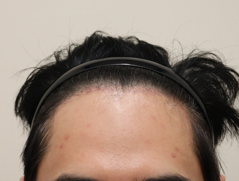 3. 수술후_1개월_1.JPG