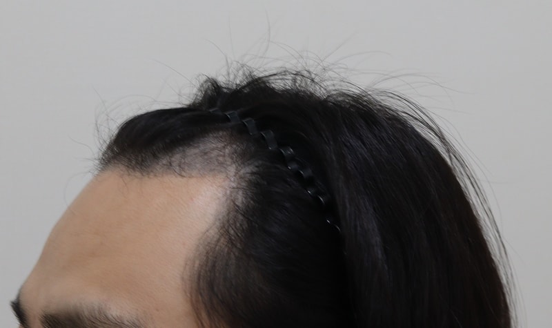 1. 수술전_3.JPG