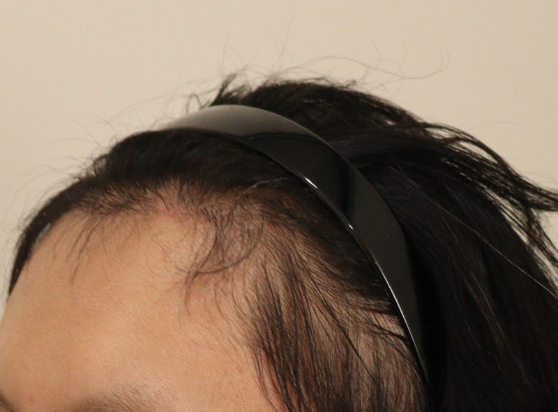 4. 수술후_6개월_3.JPG